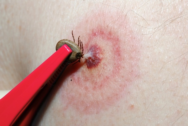 How to recognize a tick bite rash lyme disease