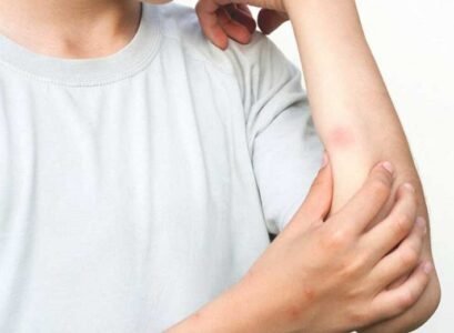 Spider-bite-or-mosquito-bite-how-to-recognize-them