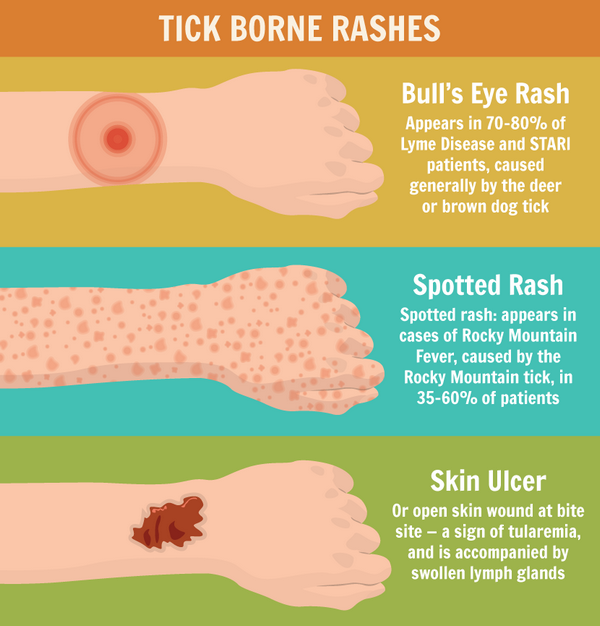 how to recognize tick borne rashes