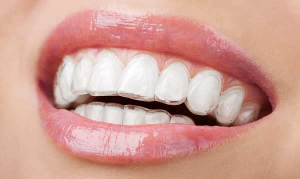 pros cons and maintenance of teeth aligners