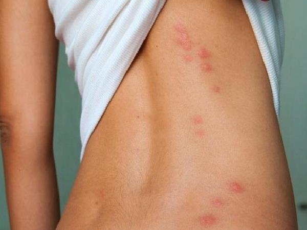 what to put on mosquito bites