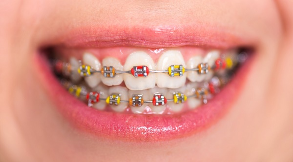 color braces ideas how to choose them