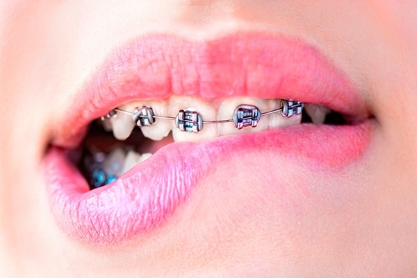 Colorful Teeth Braces Ideas Be Irresistible And Make A Fashion Statement