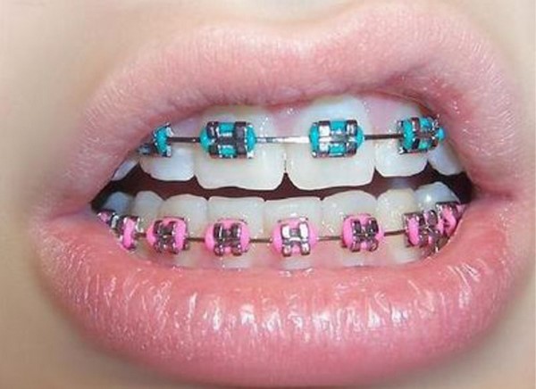 cool teeth braces pink and blue color