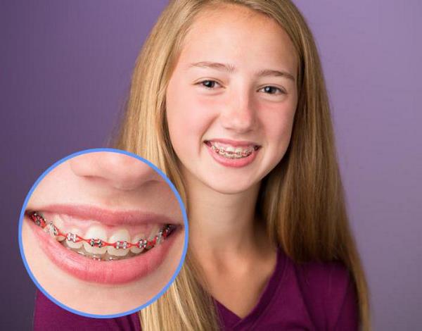 teeth braces color options funky teeth straighteners ideas
