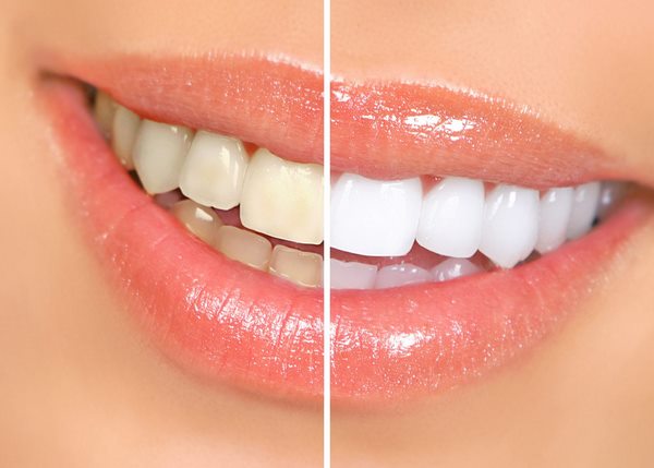 teeth whitening at home with natural ingredients