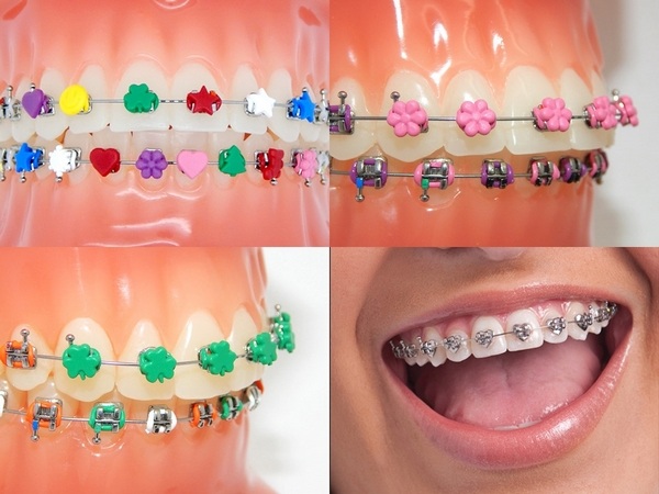 trendy and fashionable teeth braces ideas