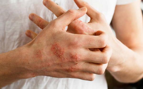 What to do in case of poison ivy rash