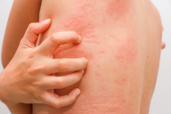 do not scratch skin rashes home remedies 