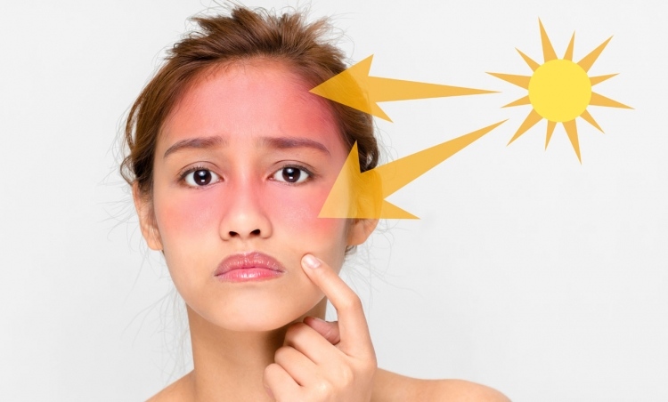 summer skin care tips sunburn prevention home remedies sunscreen 
