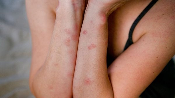 When and whom do bedbugs bite how to treat the skin