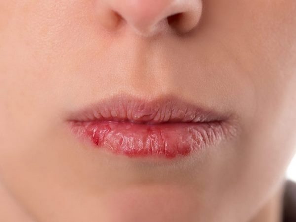 symptoms and causes of weathered lips