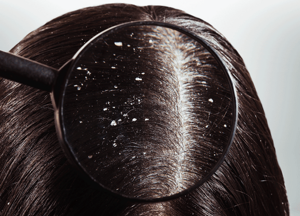 hair care and dandruff treatment with honey