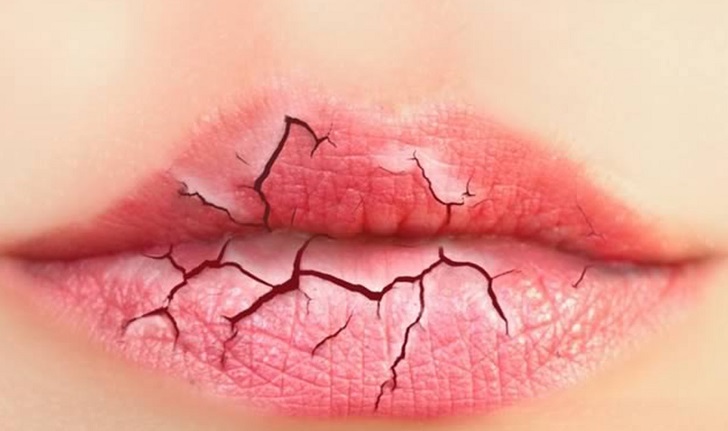 home remedies for weathered lips