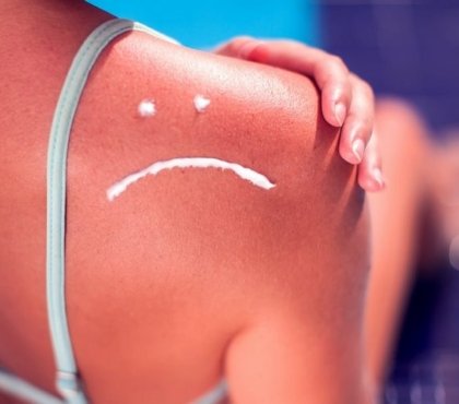 How-to-Avoid-Sunburn-and-Effective-Home-Remedies-for-Burned-Skin