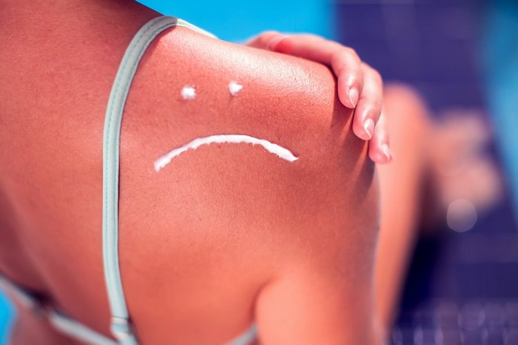 How to Avoid Sunburn Home Remedies for Burned Skin