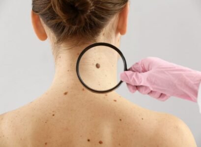 How-to-Get-Rid-Of-a-Skin-Mole-5-Home-Remedies-and-Precautions