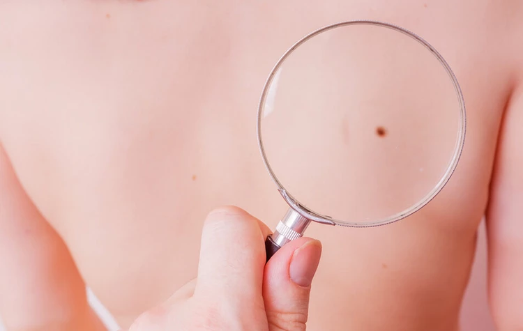 How to Get Rid Of a Skin Mole Home Remedies to try at home