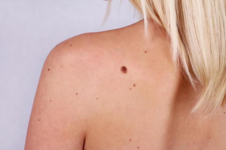 Considerations for Removing Moles at Home
