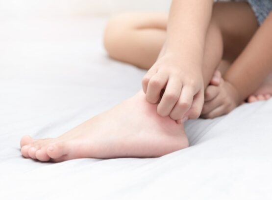 How-to-Get-Rid-of-Bedbug-Bites-Natural-Remedies-to-Relieve-the-Itching