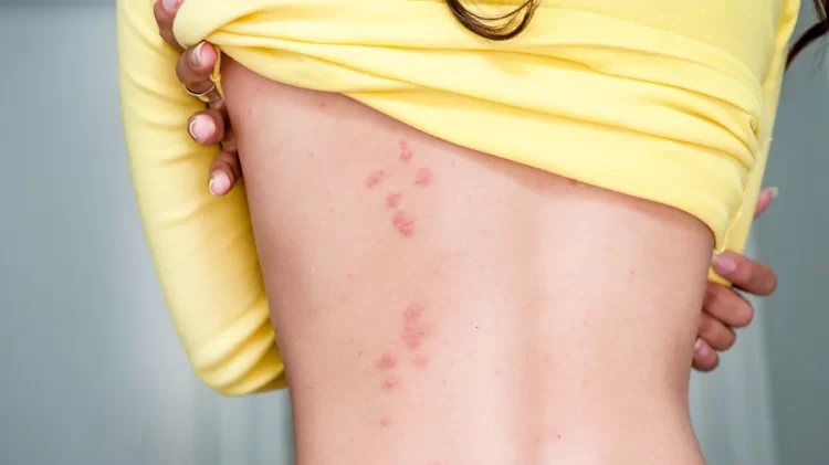 How to Get Rid of Bedbug Bites with Natural Remedies