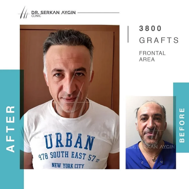 hair transplant istanbul before and after photo