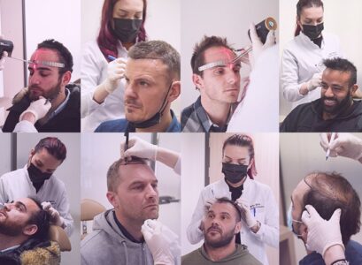 Hair-Transplant-in-Turkey-Estepera-Clinic