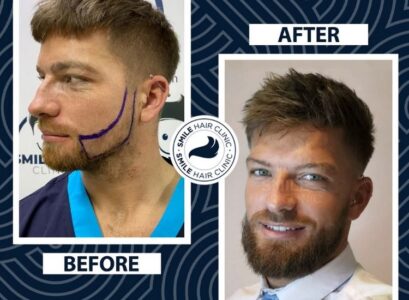 Have-Your-Hair-Transplant-in-Turkey-Smile-Hair-Clinic