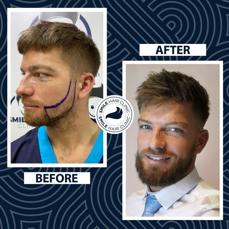 Smile Hair Clinic Have Your Hair Transplant in Turkey