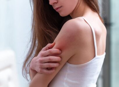 How-to-Treat-a-Heat-Rash-Best-Home-Remedies-That-Really-Work