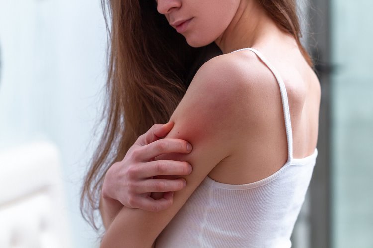 How to Treat a Heat Rash Best Home Remedies That Work