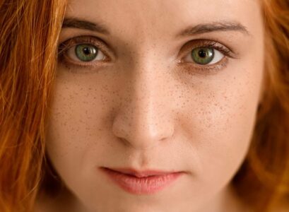 What-Are-Freckles