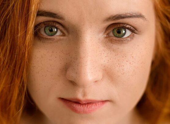 What-Are-Freckles
