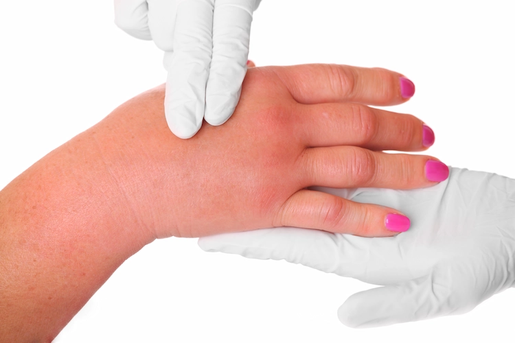 doctor examines swollen hand after wasp sting