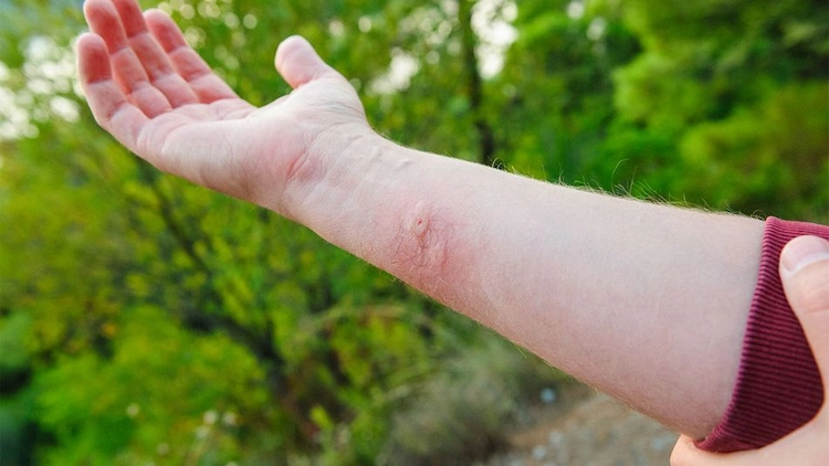 what to do after a wasp sting allergy and swelling on the skin