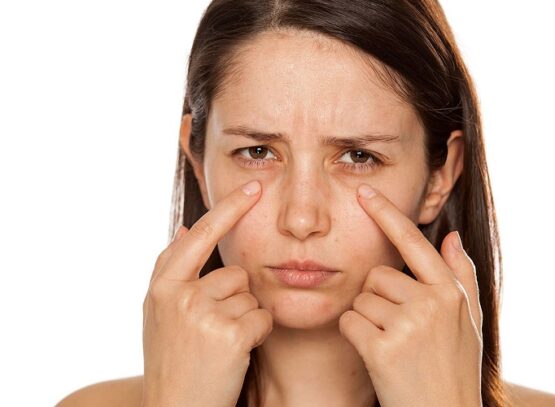 how to get rid of under eye bags home remedies treatment diet healthy lifestyle medication