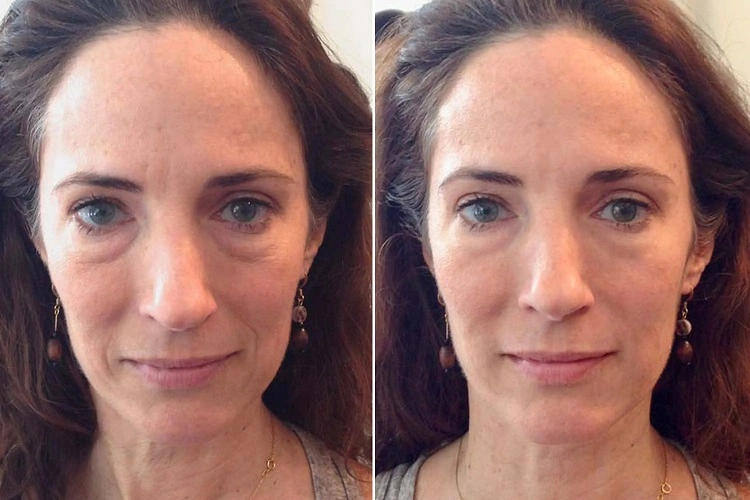 facial massage anti aging before after