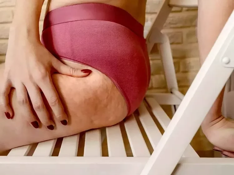 How to get rid of cellulite fast