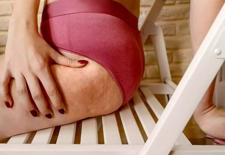 How-to-remove-cellulite-from-thighs-after-50-4-simple-and-effective-methods