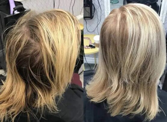 What-is-the-best-hairstyle-for-thinning-hair-must-have-accessories-and-styling-products
