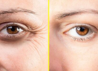 how to get rid of crow's feet without botox home remedies skin care routine
