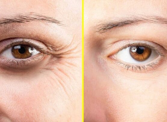 how to get rid of crow's feet without botox home remedies skin care routine