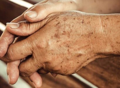 natural ways to reduce skin pigmentation_how to reduce age spots