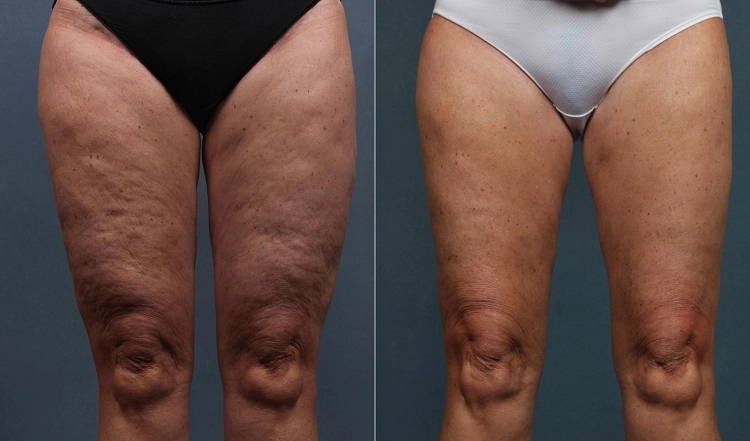 remove cellulite from thighs after 50 before after