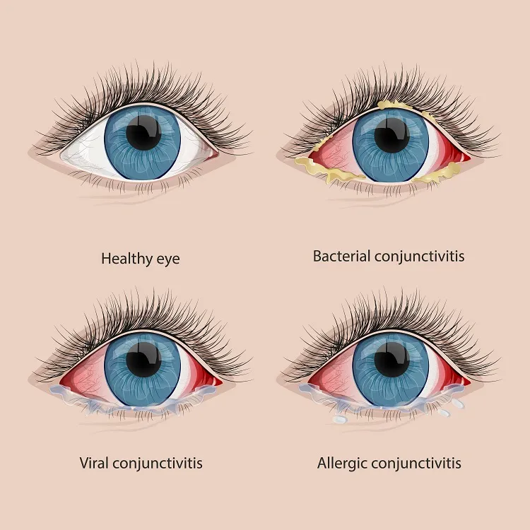 early stage pink eye symptoms-bacterial-conjunction-viral-contamination