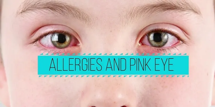 early-stage-pink- eye-symptoms-from-allergy
