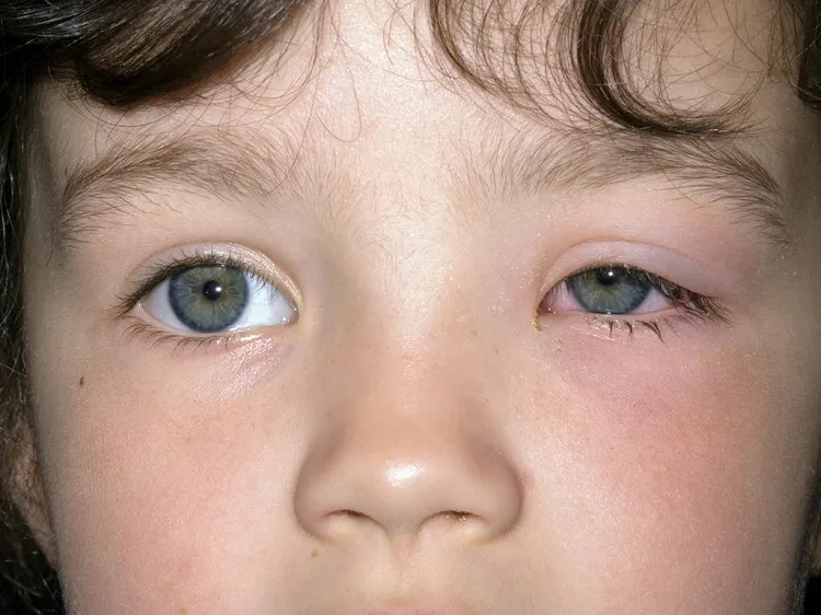 pink eye symptoms-in- toddler-unhappy-with-itchy-eyes