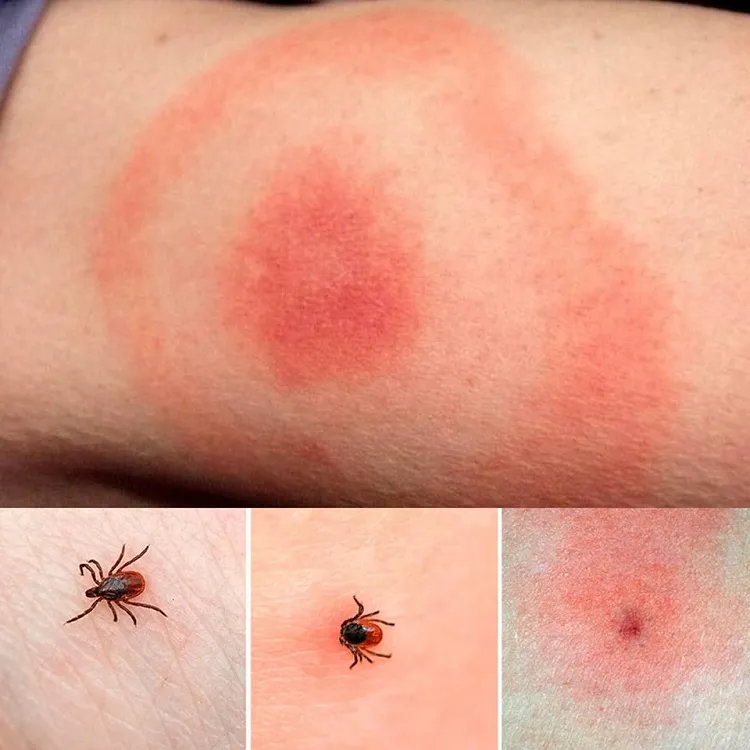 what to do after a tick bite