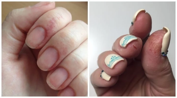 allergic reaction to wearing gel nails
