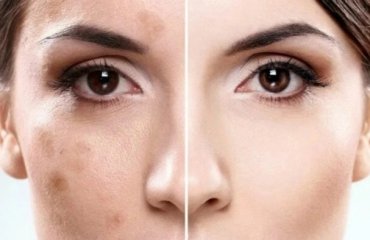 how to remove pigmentation from face home remedies